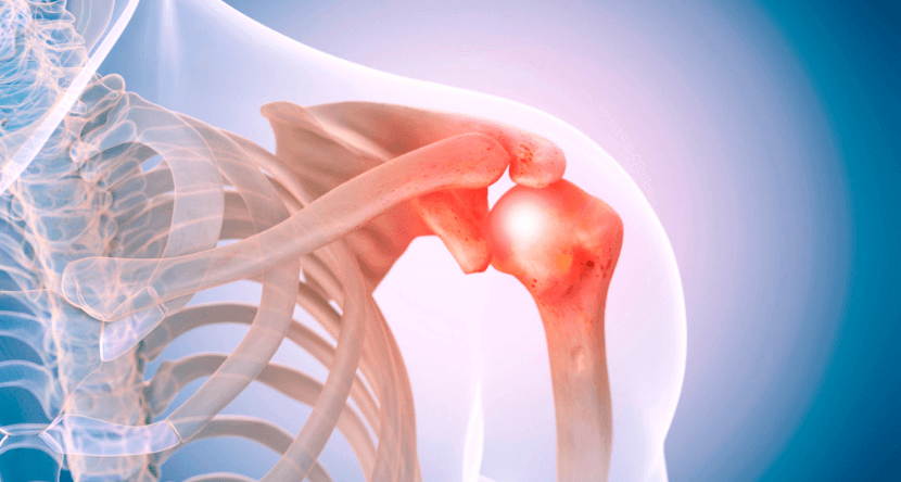 shoulder-pain-3