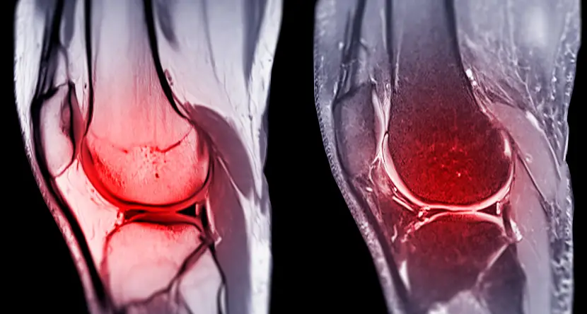 robotic-shoulder-joint-replacement-get-faster-recovery-with-amukas-expertise-1